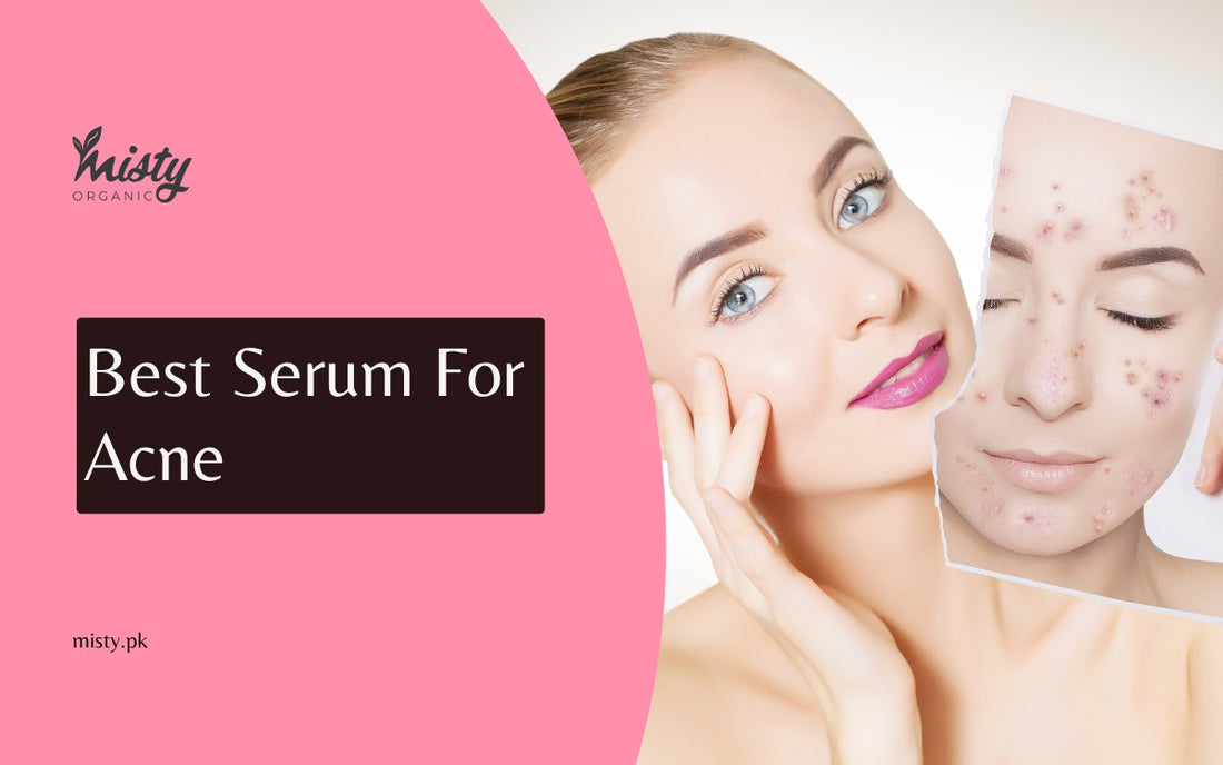 Best Serum For Acne