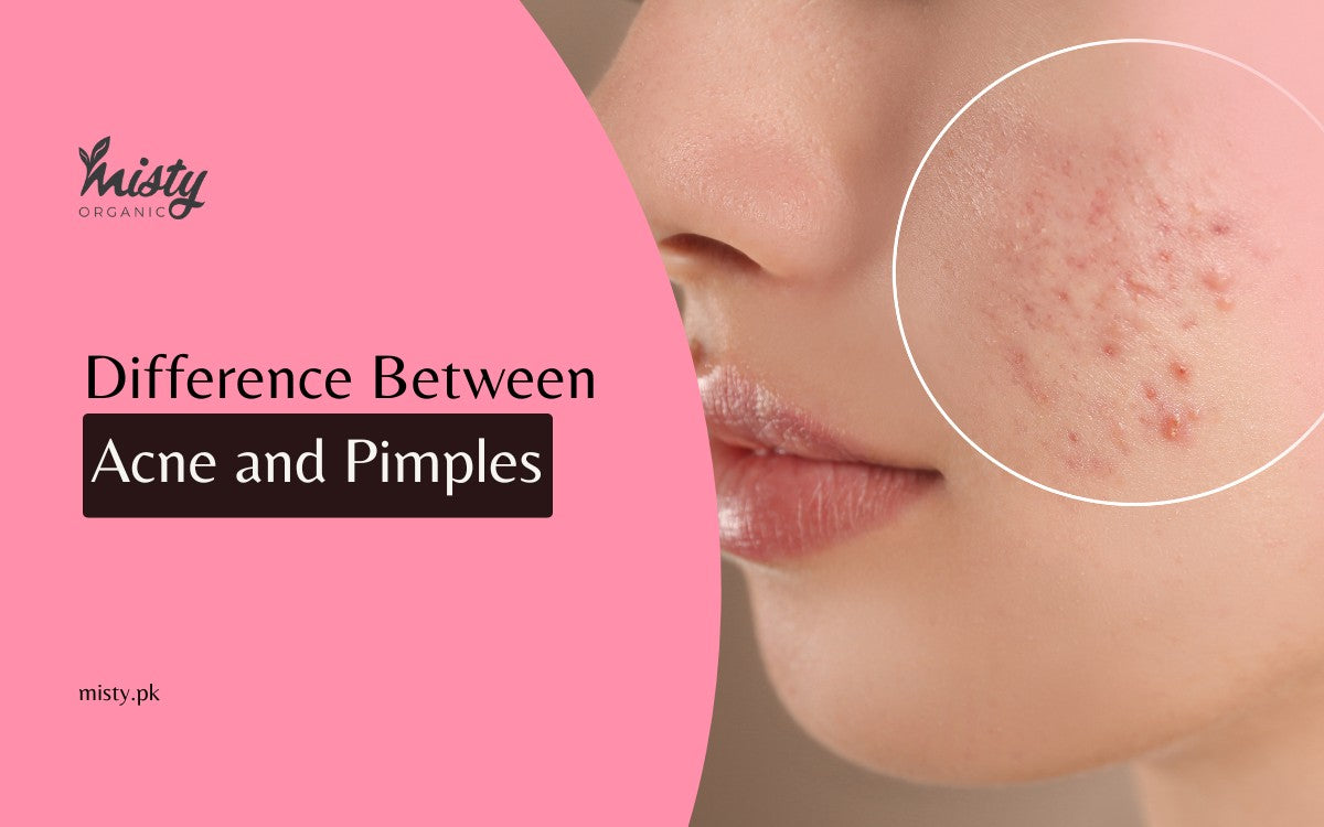 What Is The Difference Between Acne And Pimples? – Misty Organic