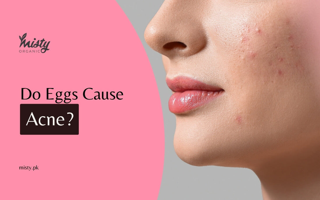 Do Eggs Cause Acne?